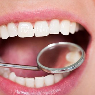 Smile inspected with dental mirror