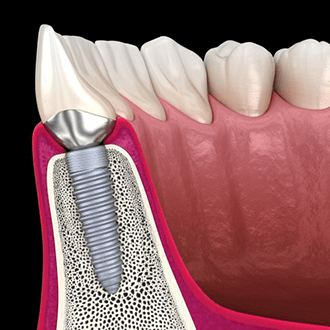 a 3D digital illustration of osseointegration and the abutment