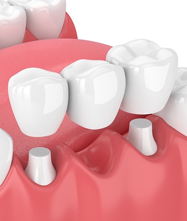 Traditional bridge and crown for tooth replacement