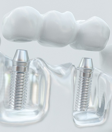 Traditional bridge and crown for tooth replacement