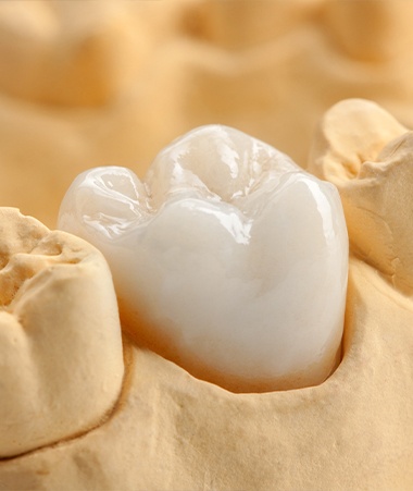 Model smile with dental crown restoration
