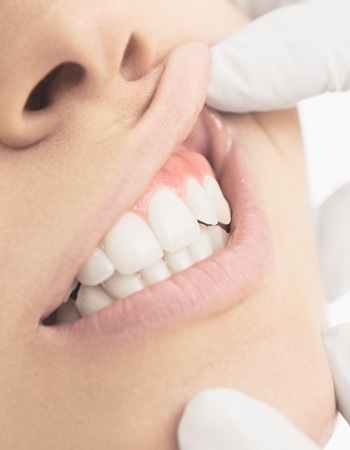 Dentist examining teeth during a dental checkup