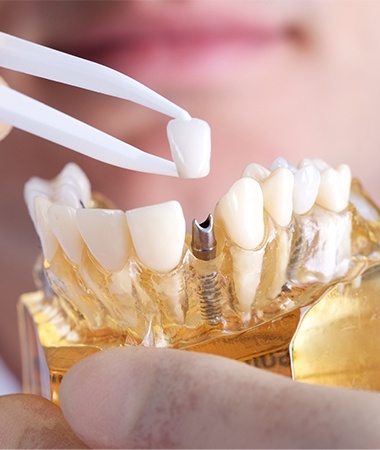 Model smile with implant supported dental crown