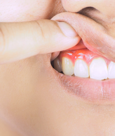 Closeup of finger lifting upper lip to reveal dark swollen gums