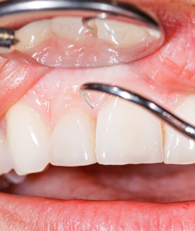 Closeup of mirror reflecting someone’s gums