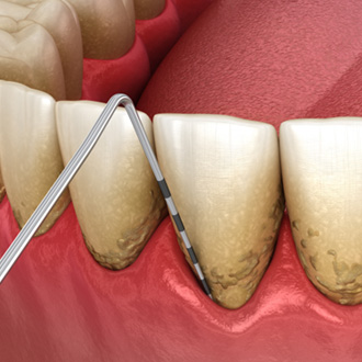 Illustration showing scaling process to remove palque