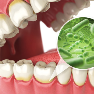 Illustration of gumline riddled with bacteria