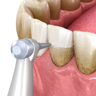 Closeup of waterjet removing plaque from enamel and gums