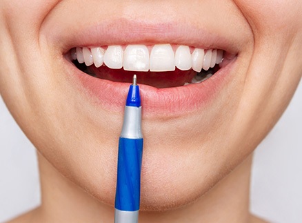 Springfield patient smiling after fluoride treatment