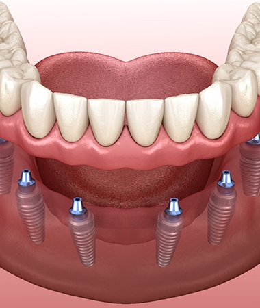A digital image 6 implant posts and a full denture on the lower arch in Springfield