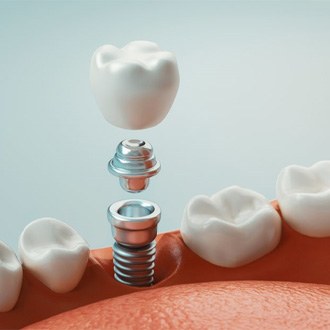 3 D illustration of the parts of dental implants