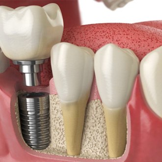 Digital illustration of dental implant