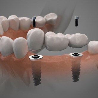 Digital illustration of implant bridge