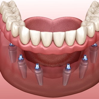 Digital illustration of implant dentures