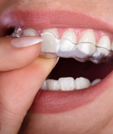 close up of person placing aligner in their mouth