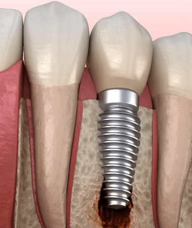 Illustration of bone loss around failed dental implant in Springfield, NJ