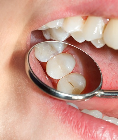 Close-up of molar with protective dental sealant
