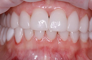 Closed gaps between teeth