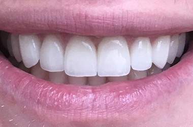 Bright white teeth