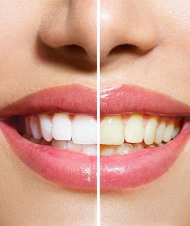 Smile before and after teeth whitening