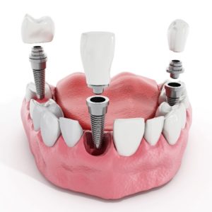 Model showing the basics of dental implants