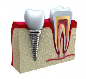 anatomy of healthy teeth and dental implant illustration