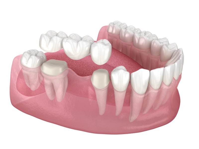 A close-up 3D illustration of a dental bridge