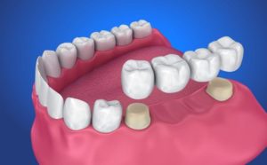 An illustration of a dental bridge being placed